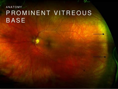 prominent vitreous base optos