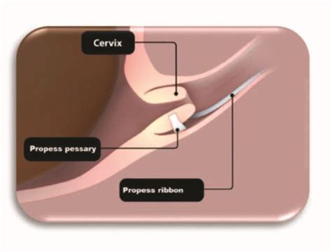Propess Induction How Does It Work