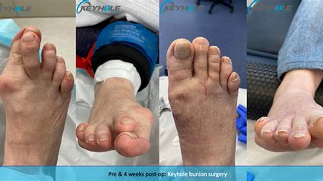 Bunion Surgery: Pros and Cons