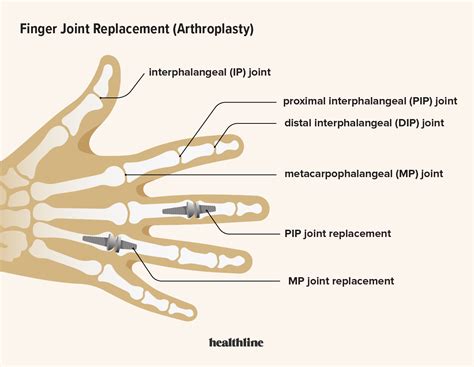 pros and cons of finger joint replacement