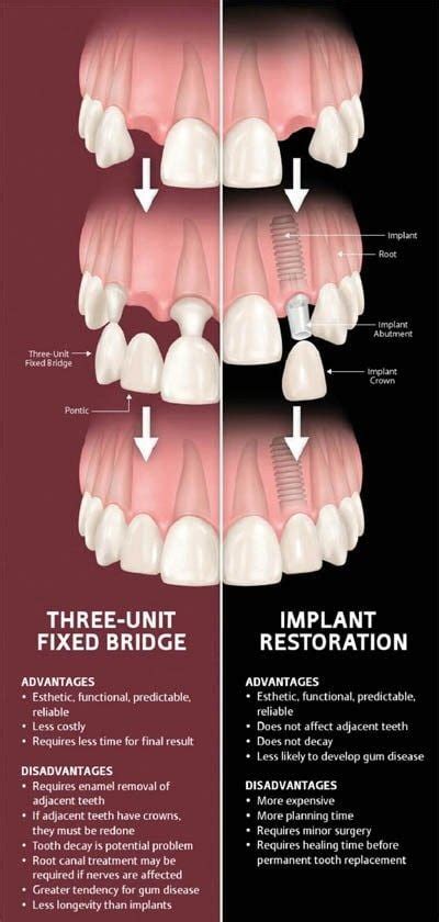 pros cons bridge versus implant