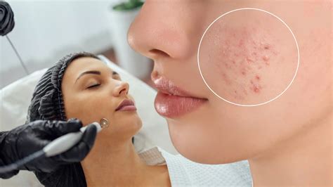 prosedur laser jerawat