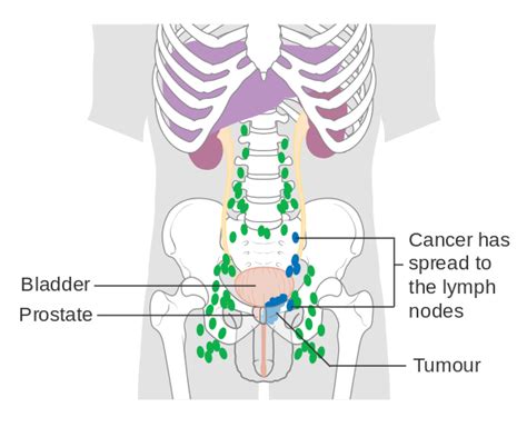 prostate cancer lymph nodes spread