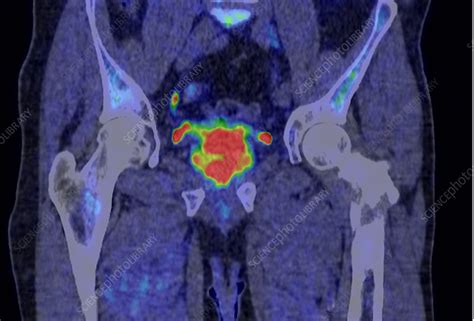 prostate pet scan cost