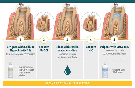 Protocol Of Irrigation In Endodontics