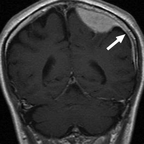 pseudotumor in brain