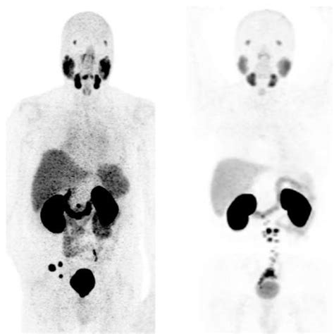 psma pet scan cpt code 2022