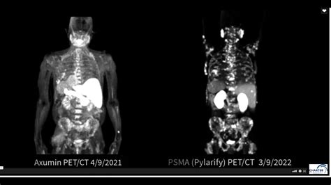 psma pet scan locations in virginia