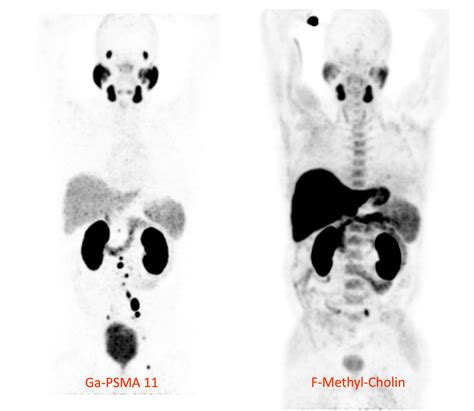 psma pet scan what is it