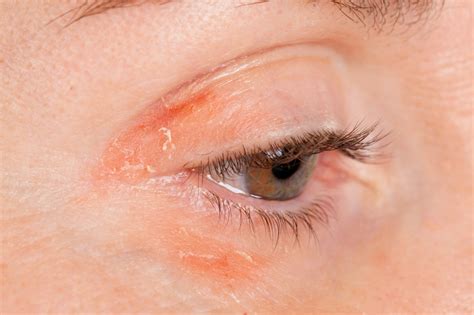 psoriasis and eye inflammation