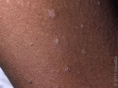 Managing Psoriasis on Dark Skin: Challenges and Solutions