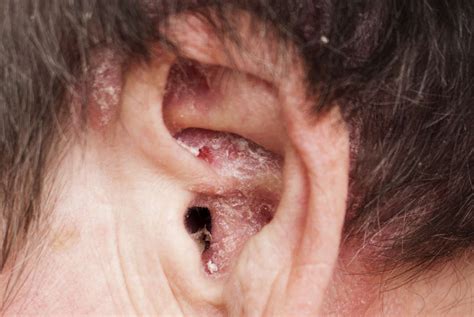 psoriasis ear drum