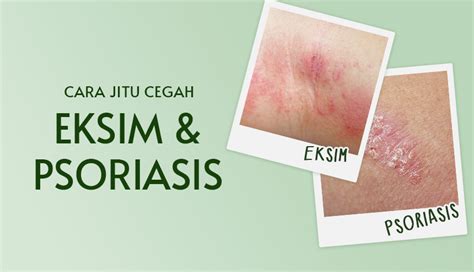 Kulit psoriasis eksim