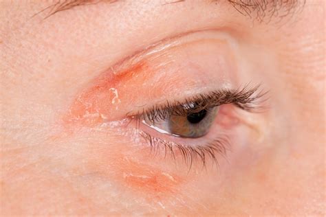 psoriasis eyes pictures