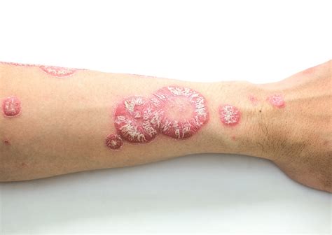 psoriasis on the rise