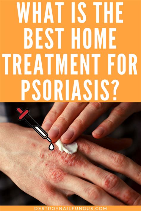 psoriasis relief try these today