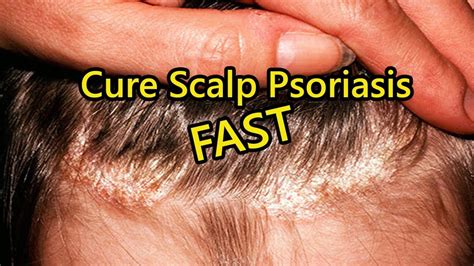 psoriasis treatment scalp home remedies