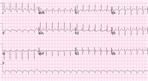 psvt example ekg