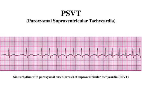 psvt heart