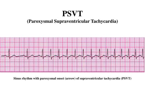 psvt paroxysmal supraventricular tachycardia