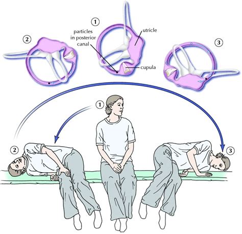 Pt Exercises For Positional Vertigo