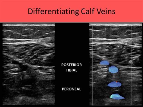 ptv and peroneal veins on ultrasound