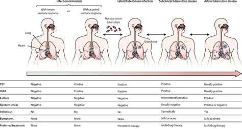 public health model for tuberculosis