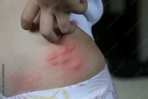 What Causes a Puffy Insect Bite and How to Treat It