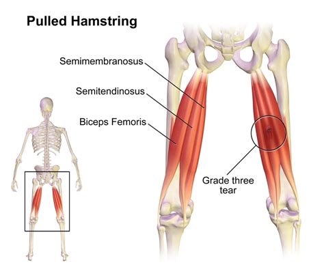 Pulled Hamstring Diagram