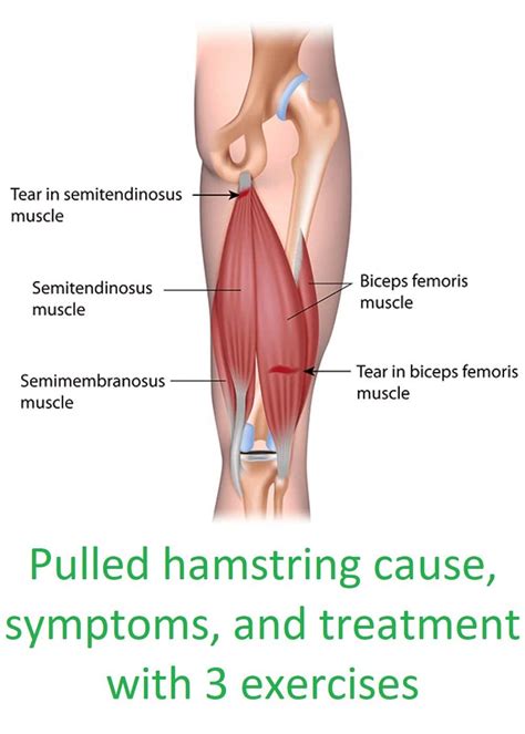 Pulled Hamstring During Sleep