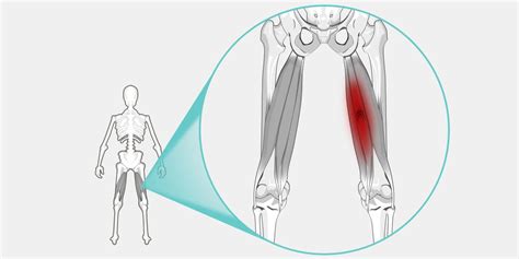 Pulled Hamstring En Espanol