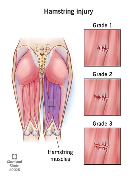 Pulled Hamstring Groin Pain