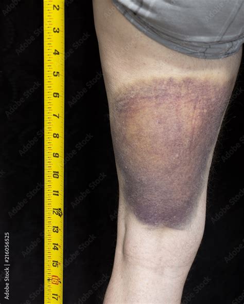 Pulled Hamstring Large Bruise
