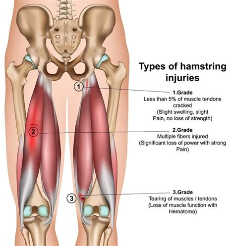 Pulled Hamstring Won't Heal