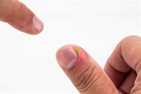 Pulled Off Hangnail Infected