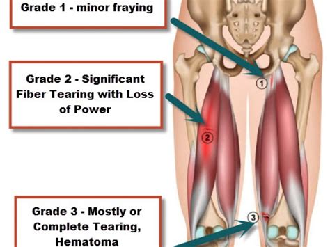 Pulled Upper Leg Muscle