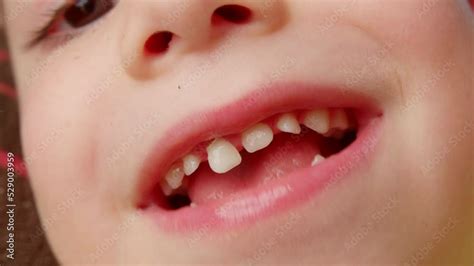 Pulling Child's Front Tooth