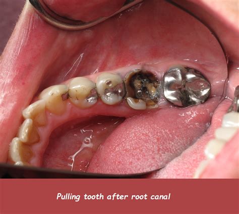 Root canal treatment process. 3D illustration Hancock Village Dental Dentist Clermont Florida