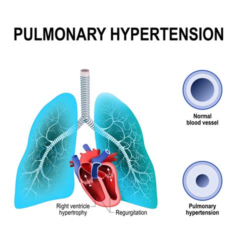 pulmonary arterial hypertension causes