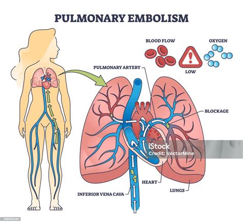 Pulmonary Embolism Flow