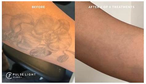 Pulse Light Clinic Tattoo Removal Aftercare Laser At London YouTube