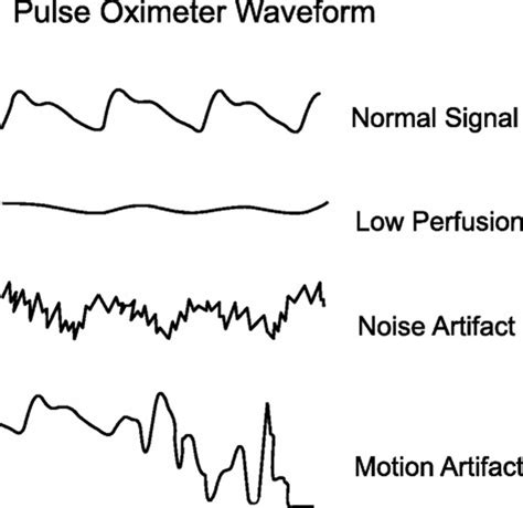 Pulse Oximetry Waveform