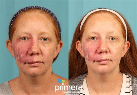 Pulsed Dye Laser: Advanced Skin Treatment for Vascular Lesions