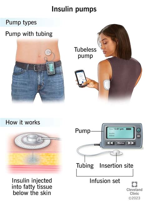Pump Diabetes