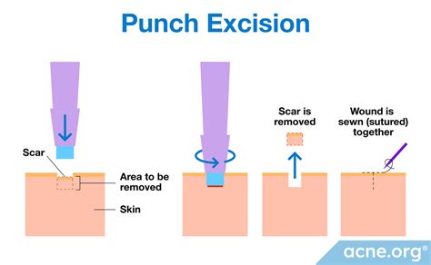 punch excision