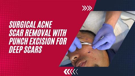 Punch Excision Scar Removal