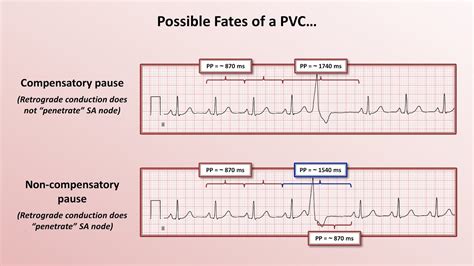 Understanding PVCs and PACs: Cardiac Rhythm Insights Revealed