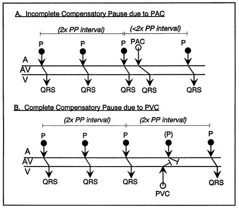 Pvcs Are Usually Followed By An Incomplete Compensatory Pause