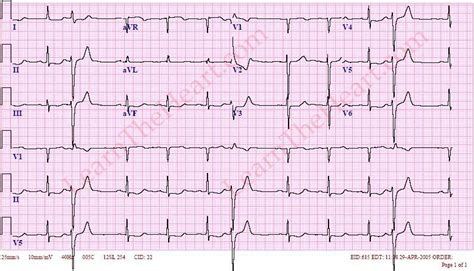 Understanding PVCs on EKG: Causes, Symptoms, and What You Need to Know