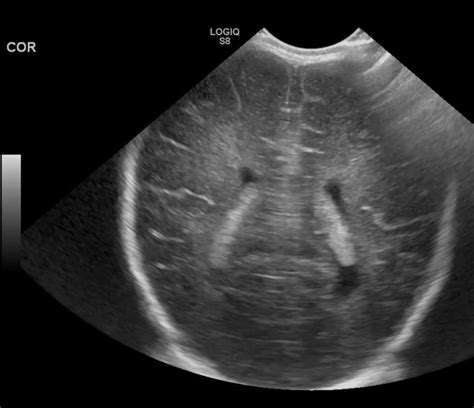 pvl cranial ultrasound